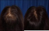 67 year old woman treated with Hair Loss Treatment
