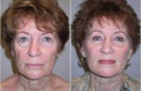 67 year old woman treated with Facelift and Periorbital Rejuvenation