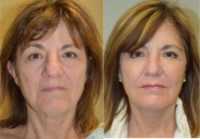 67 year old woman treated with Facelift, facial fat grafting, and blepharoplasty