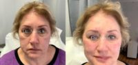 65-74 year old woman treated with Nonsurgical Facelift