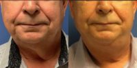 65-74 year old man treated with Facelift, Neck Lift