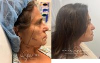75 and up year old woman treated with Facelift, Deep Plane Facelift