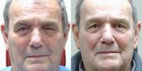 75 and up year old woman treated with Ptosis Surgery