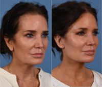 54 year old female after deep plane facelift, necklift, facial fat grafting, ear lobe reduction, and upper eyelid lift.