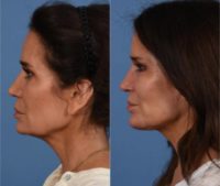 54 year old female after deep plane facelift, necklift, facial fat grafting, ear lobe reduction, and upper eyelid lift.