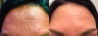 35-44 year old woman treated with Botox with skin regimen