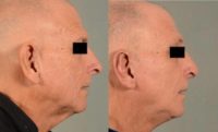 65-74 year old man treated with Facial
