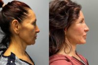 45-54 year old woman treated with Deep Plane Facelift, Facial Fat Transfer, Renuvion, Laser Resurfacing