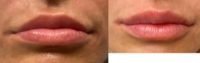 35-44 year old woman treated with Lip Fillers