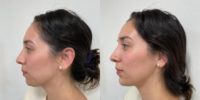 25-34 year old woman treated with Chin and Cheek Filler