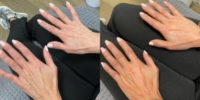 55-64 year old woman treated with Restylane Lyft for hand rejuvenation