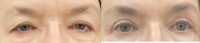 65-74 year old woman treated with Eyelid Surgery