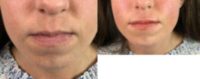 18-24 year old woman treated with Restylane