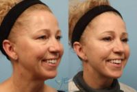 59 year old woman treated with Facelift