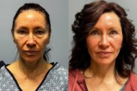 45-54 year old woman treated with Deep Plane Facelift, Facial Fat Transfer, Renuvion, Laser Resurfacing