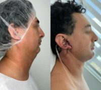 35-44 year old man treated with Neck Lift