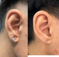 18+ year old man treated with Ear Surgery