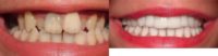 35-44 year old woman treated with Porcelain Veneers