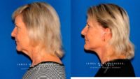 45-54 year old woman treated with Facelift, Deep Plane Facelift, Lower Facelift