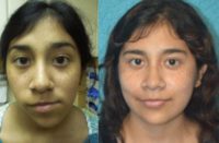 17 or under year old woman treated with Facial Reconstructive Surgery