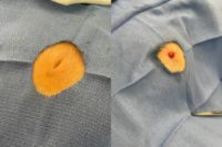 35-44 year old woman treated with Inverted Nipple Surgery