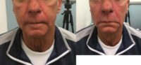 55-64 year old man treated with Restylane Lyft for Cheek Augmentation