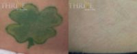 18-24 year old woman treated with Tattoo Removal