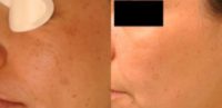25-34 year old woman treated with Fraxel Laser