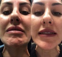 34 year old girl treated with Botox on the chin
