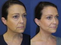 47 year old woman treated with facelift, blepharoplasties, and fat grafts to face