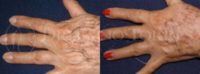 65-74 year old woman treated with Hand Rejuvenation