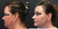 35-44 year old woman treated with Non-Surgical Neck Lift
