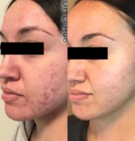 25-34 year old woman with acne treated with Chemical Peel