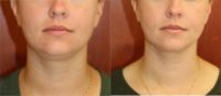 33 year old woman treated with Kybella