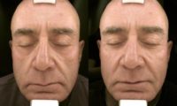 63 year old man treated with Voluma and Restylane