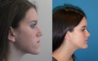 17 year old female Jaw Reduction