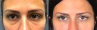 25-34 year old woman treated with Restylane