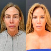 58 years-old woman treated with a revision facelift, neck lift, eyelid surgery, and fat transfer to face.