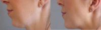 Jawline sculpting treated with CoolSculpting and Juvederm VOLUX Injectable Dermal Filler