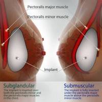 Breast-implant-position Subglandular and Submuscular
