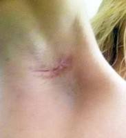 Popular breast augmentation armpit incision