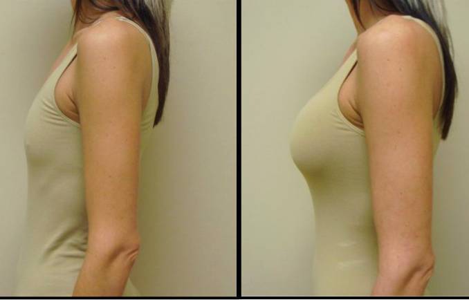 Seattle Breast Augmentation Before And After " Breast Augmentation: Co...