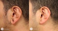 47 year old with large gauge earlobe holes treated with removal of holes, earlobe reduction and lift