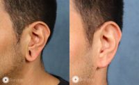 47 year old with large gauge earlobe holes treated with removal of holes, earlobe reduction and lift