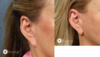 correction of pixie earlobe after facelift