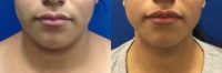 Woman treated with Chin Liposuction