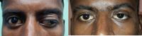 18-24 year old man treated with Ptosis Surgery