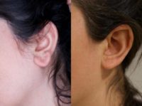 18-24 year old woman treated with Earlobe Surgery