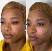 25-34 year old woman treated with Dermal Fillers, Nonsurgical Nose Job