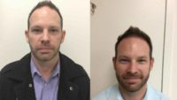 40 year old man treated with FUE Hair Transplant